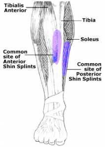 Shin Splints Physiotherapy Treatment | Metro Physio