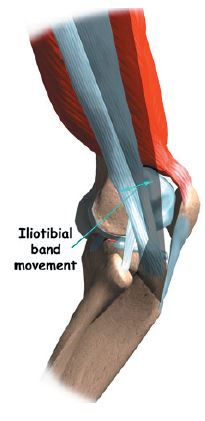 Iliotibial Band Syndrome (ITB) Physiotherapy