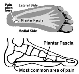 Plantar Fasciitis- Ankle Pain Physiotherapy | Metro Physio