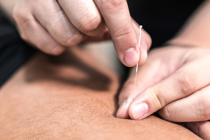 Acupuncture in Wirral